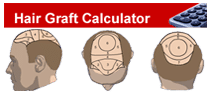 Hair Graft Calculator