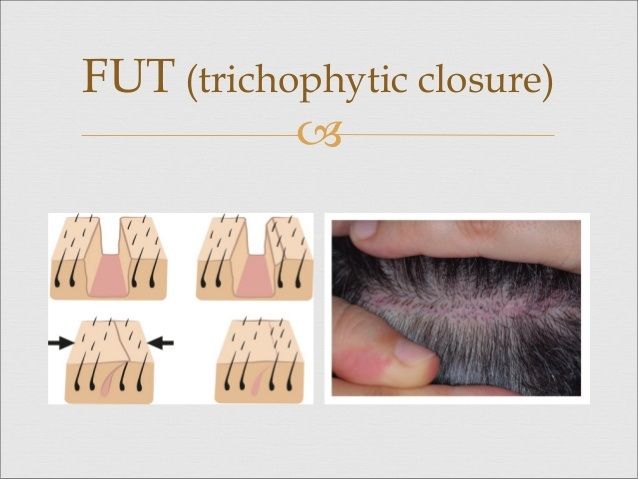 Trichophytic closure