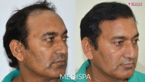 Benefits of Getting the Combined Technique of Hair Transplant