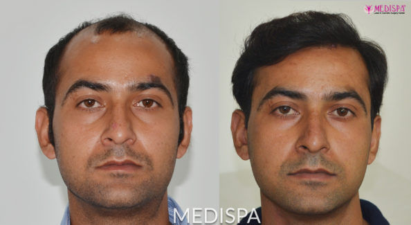 hair transplant result