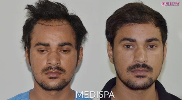Cost of Hair Transplant