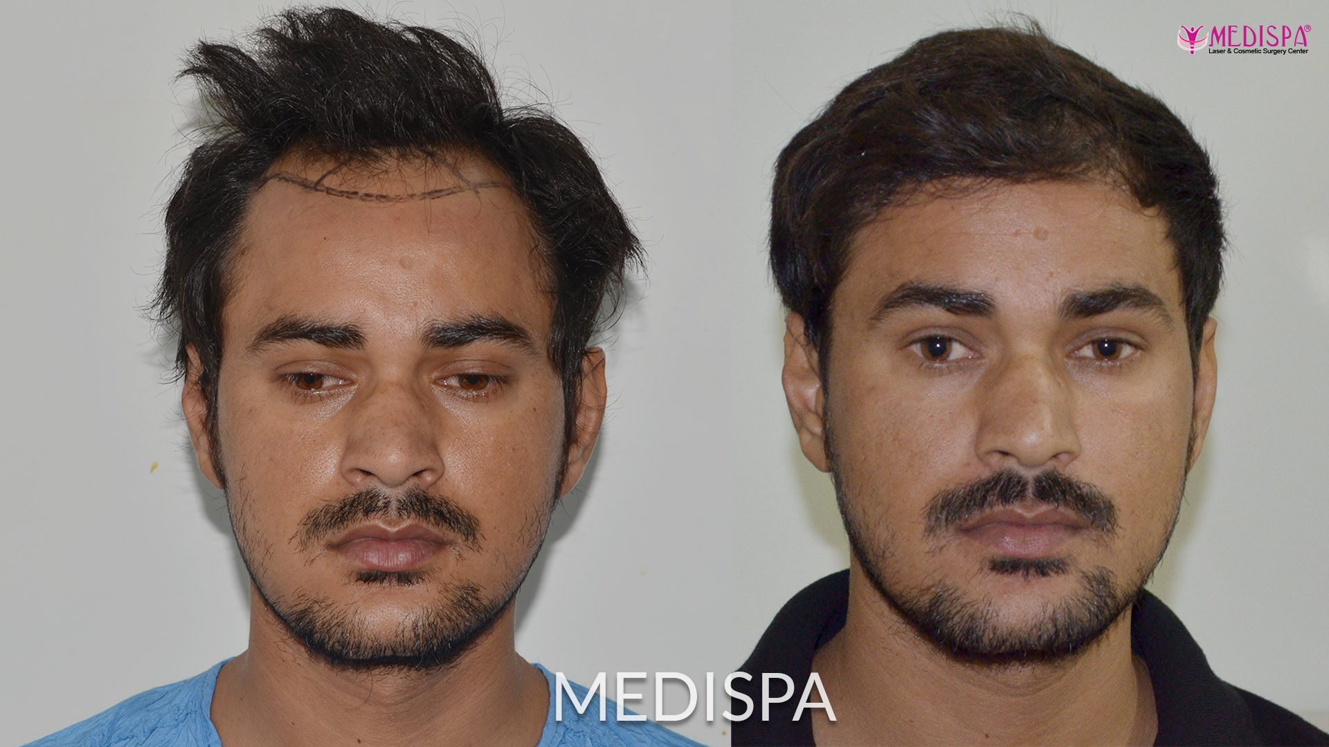 Cost of Hair Transplant
