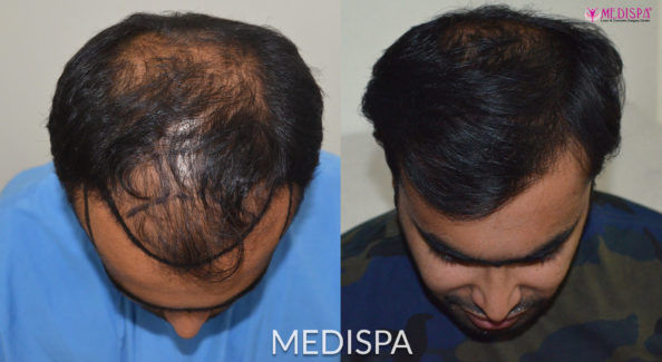 hair transplant cost in Delhi