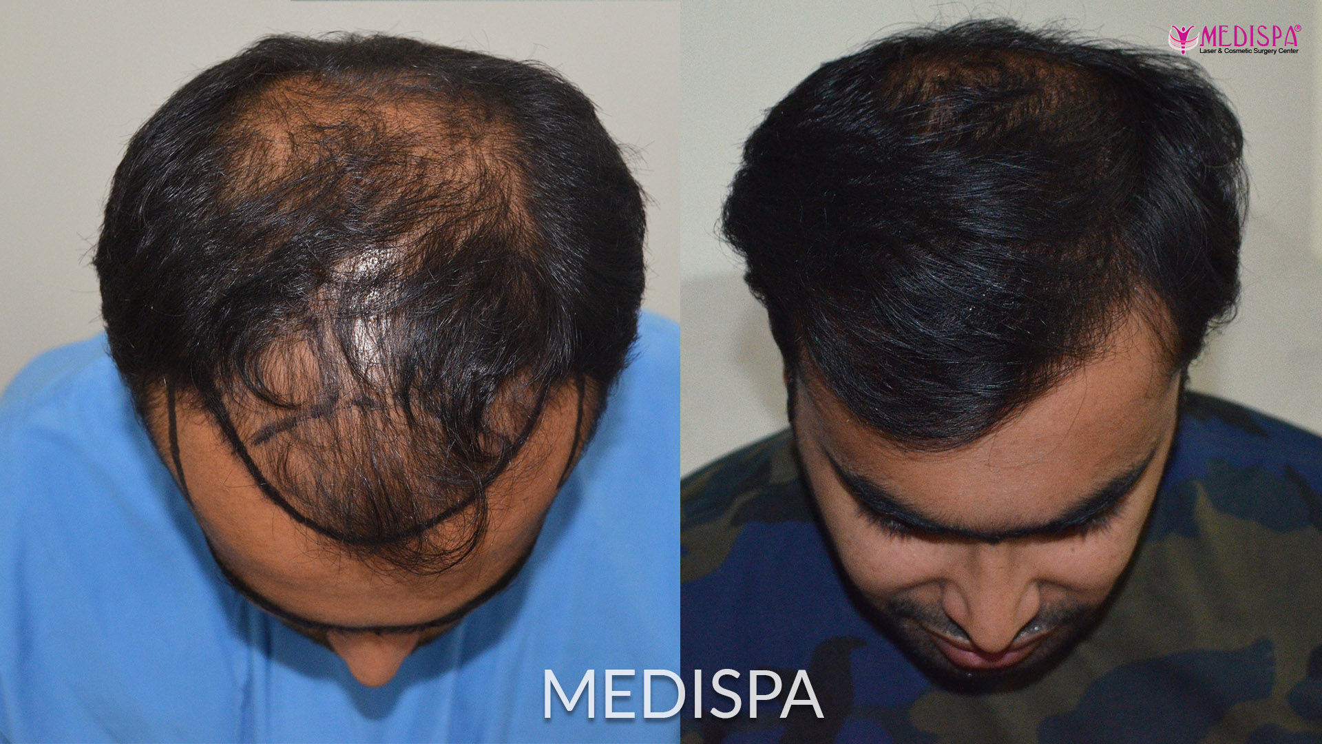 hair transplant cost in Delhi