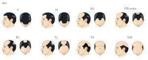 norwood baldness scale