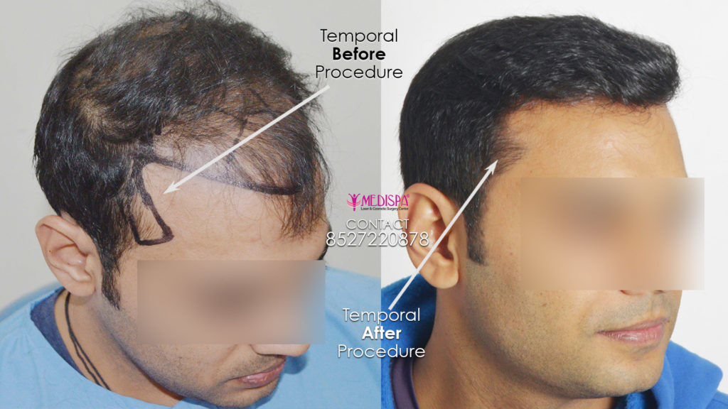 high density hair transplant