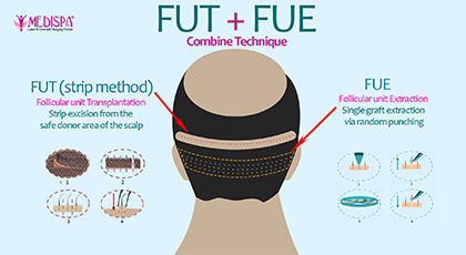 Combination Method FUT + FUE