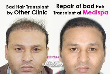 Wrong Hair Transplant Repair