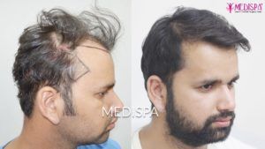 What are the Possible Side-Effects Associated with a Hair Transplant