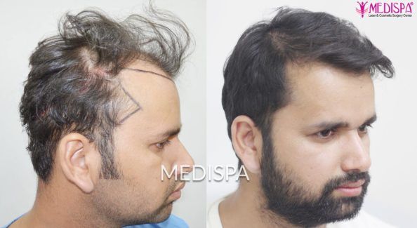 hair transplant in india
