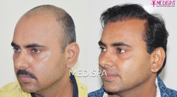 Hair Transplant cost in India