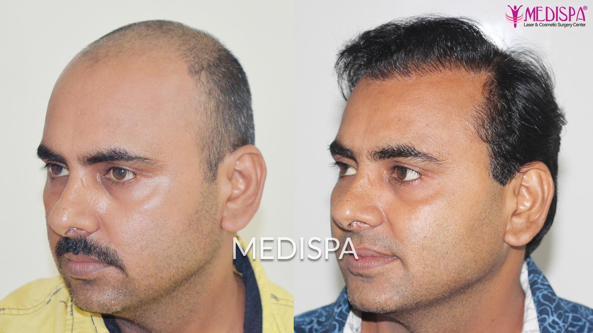Hair Transplant cost in India