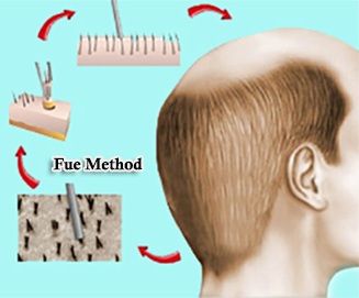 FUE hair transplant