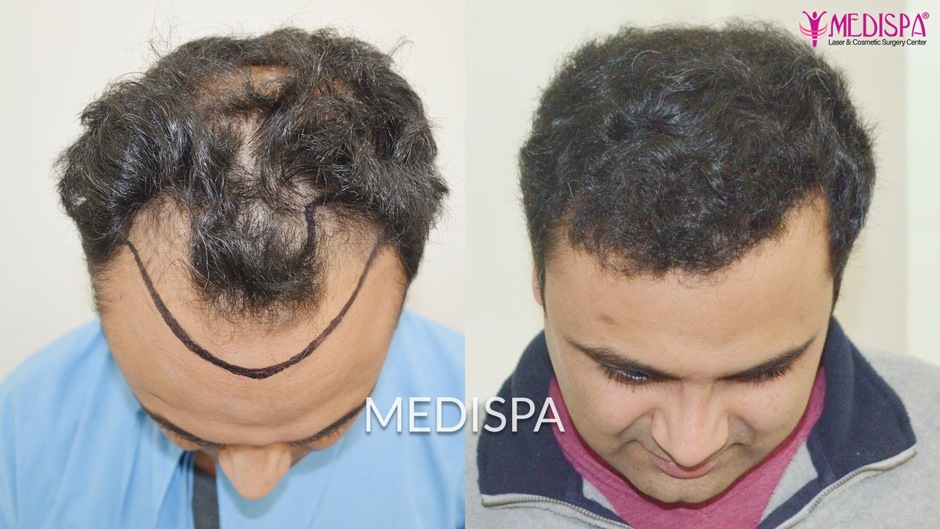 Hair Transplant in India