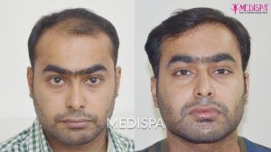 Why Should You Go with the Hair Transplant Procedure