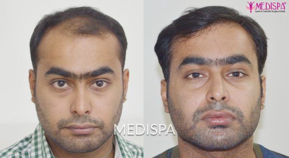 Hair Transplant in India