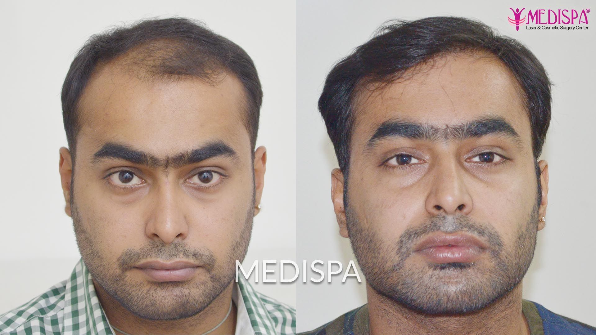 Hair Transplant in India
