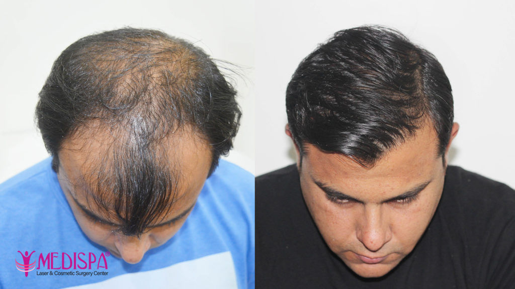 hair restoration results rajasthan