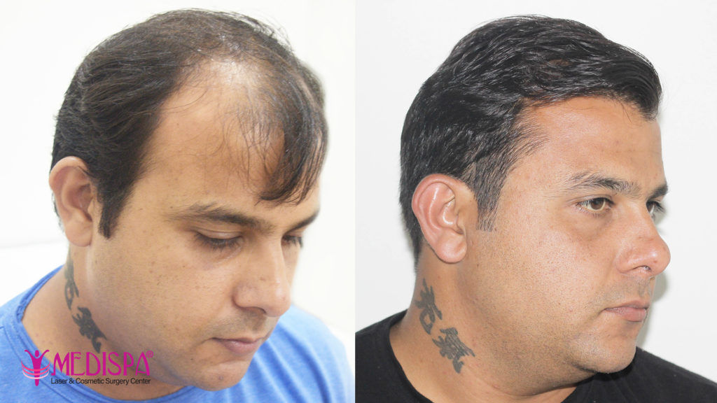 hair restoration after and before