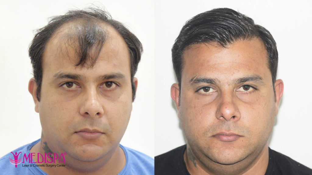 hair transplant indore