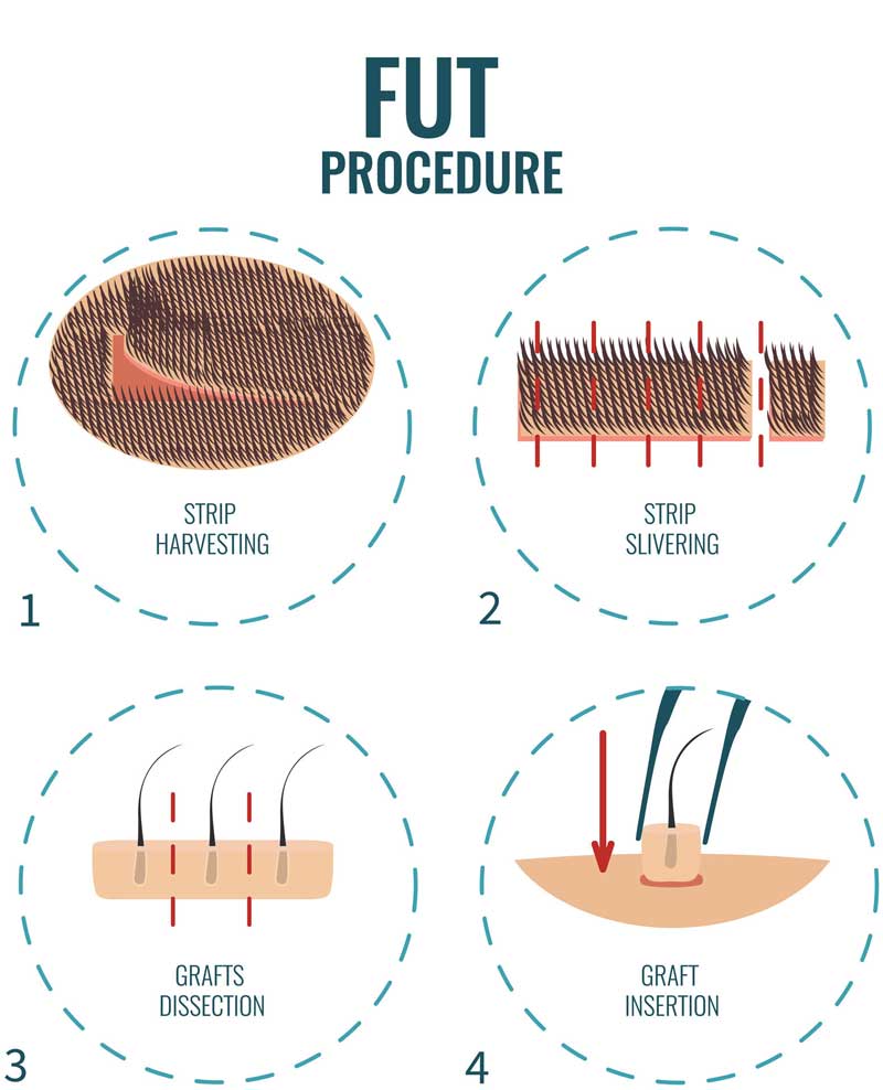 FUT Hair Transplant Procedure