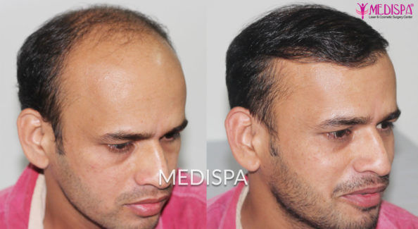 Hair Transplant