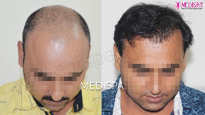 Hairline Design in the Hair Transplant Procedure