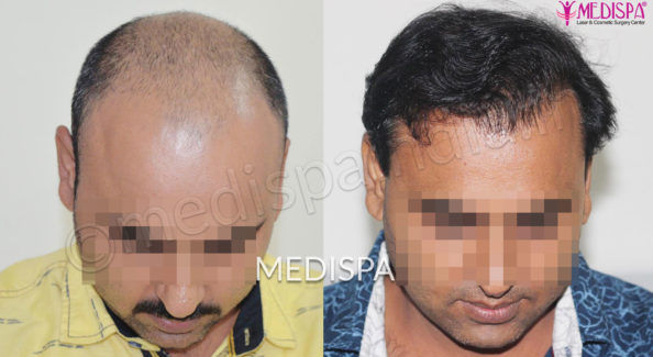 Hair Transplant
