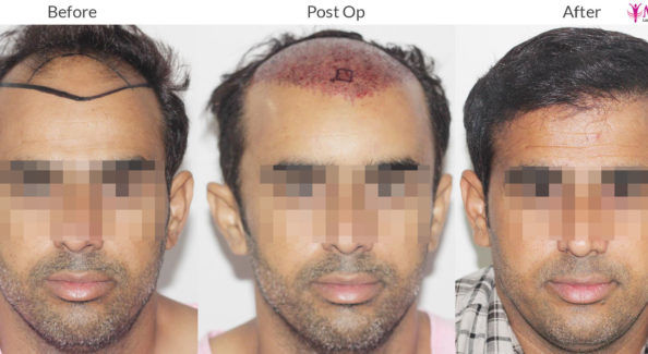 Hair Transplant Surgery