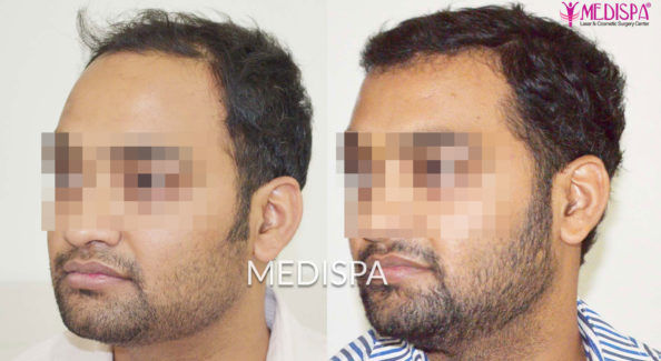 Hair-Transplant-in-Delhi-India