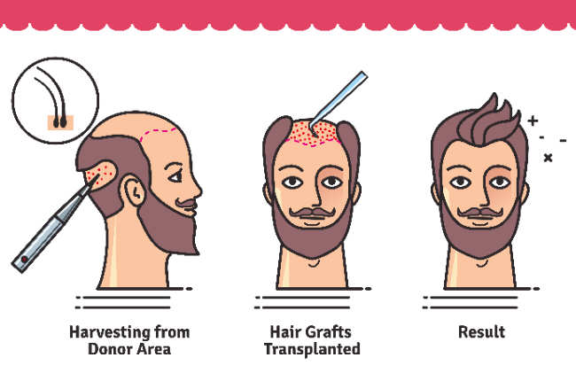 Procedure of hair transplant