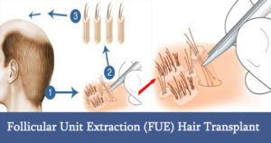 Everything you need to know about FUE