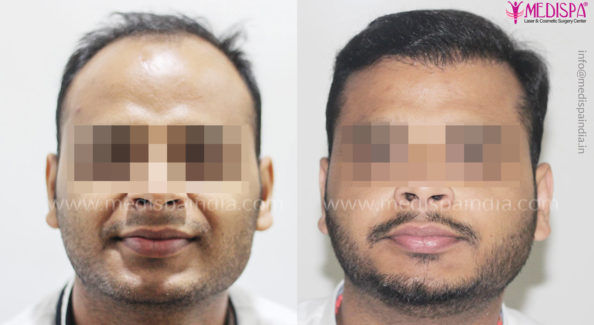 hair-transplant