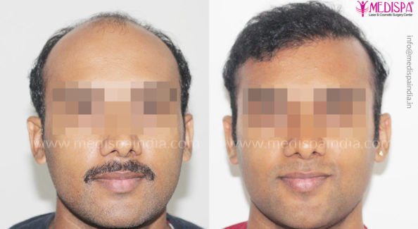 Hair Transplant in India