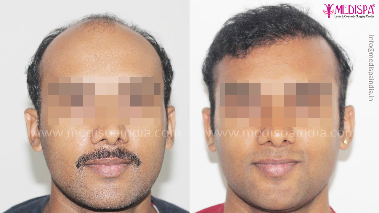 Hair Transplant in India
