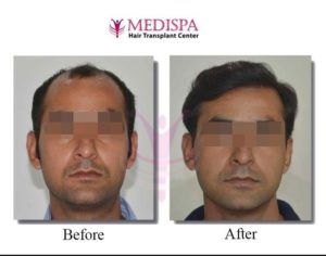 Guidelines to follow to get Successful Hair transplant in Bangalore