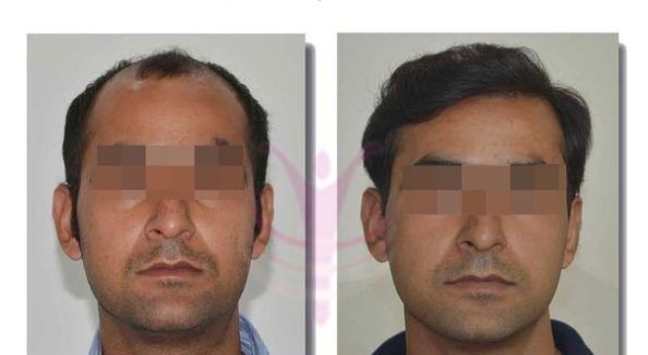 hair transplant results