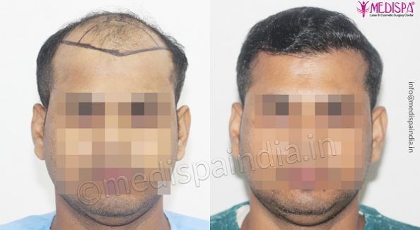Hair Transplant in USA