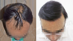 What is the Significance of Primary Consultation in Hair Transplants