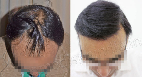 Hair Transplant Cost
