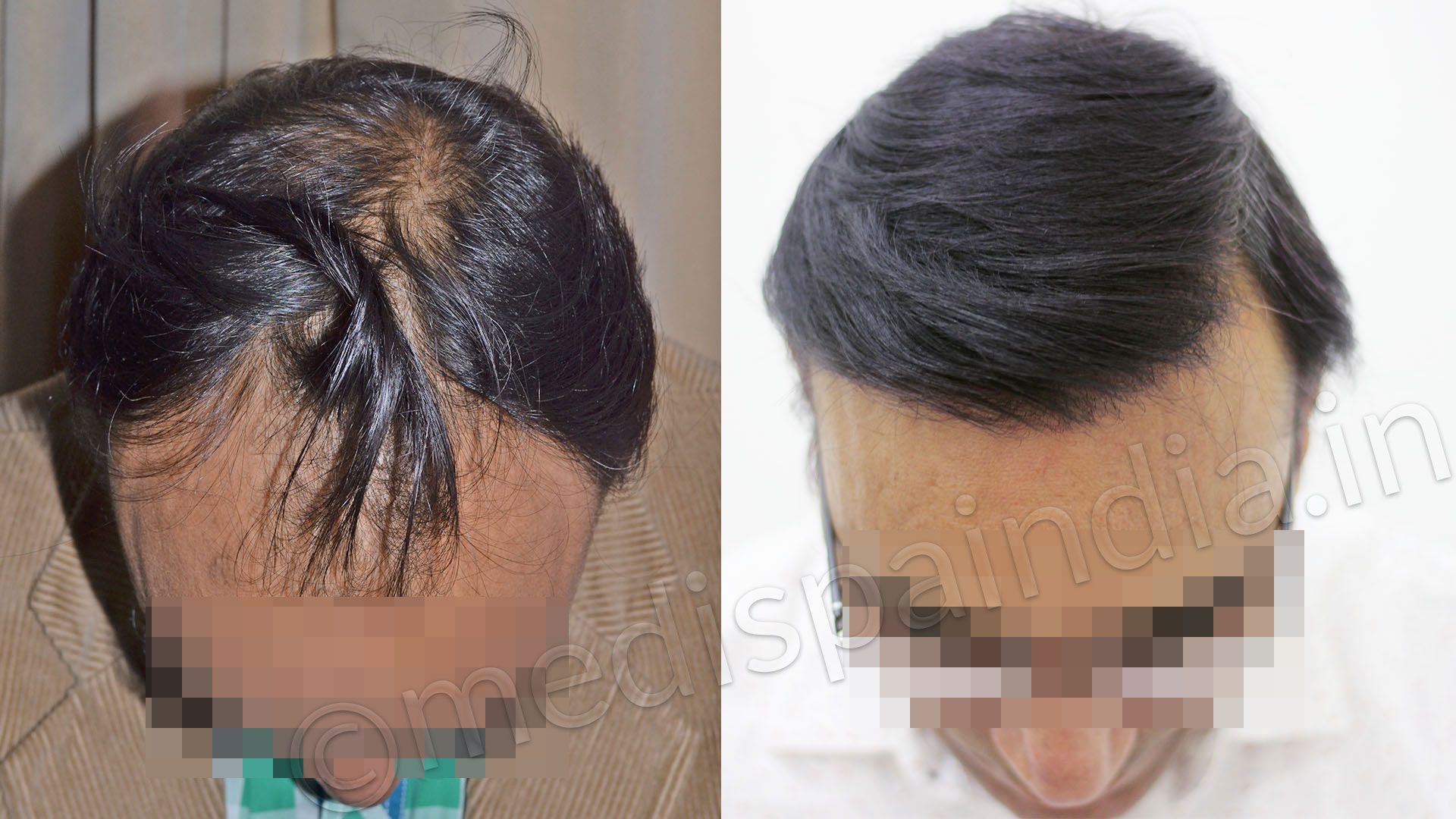 Hair Transplant Cost