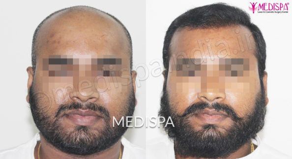 Hair Transplant in India Cost