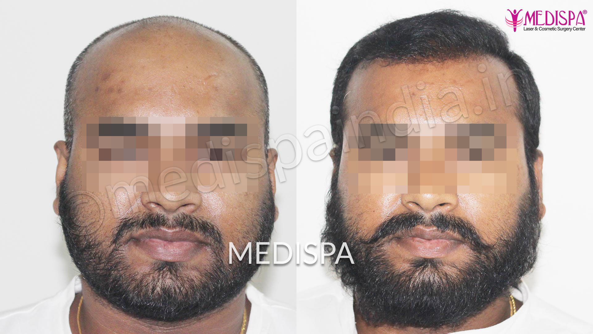 Hair Transplant in India Cost