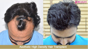 How much is it Important to Undergo for Hair Restoration