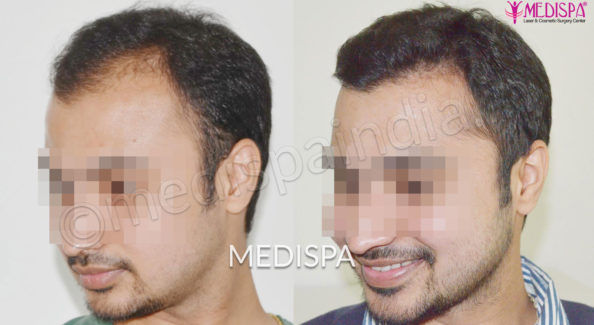 Hair Transplant in India