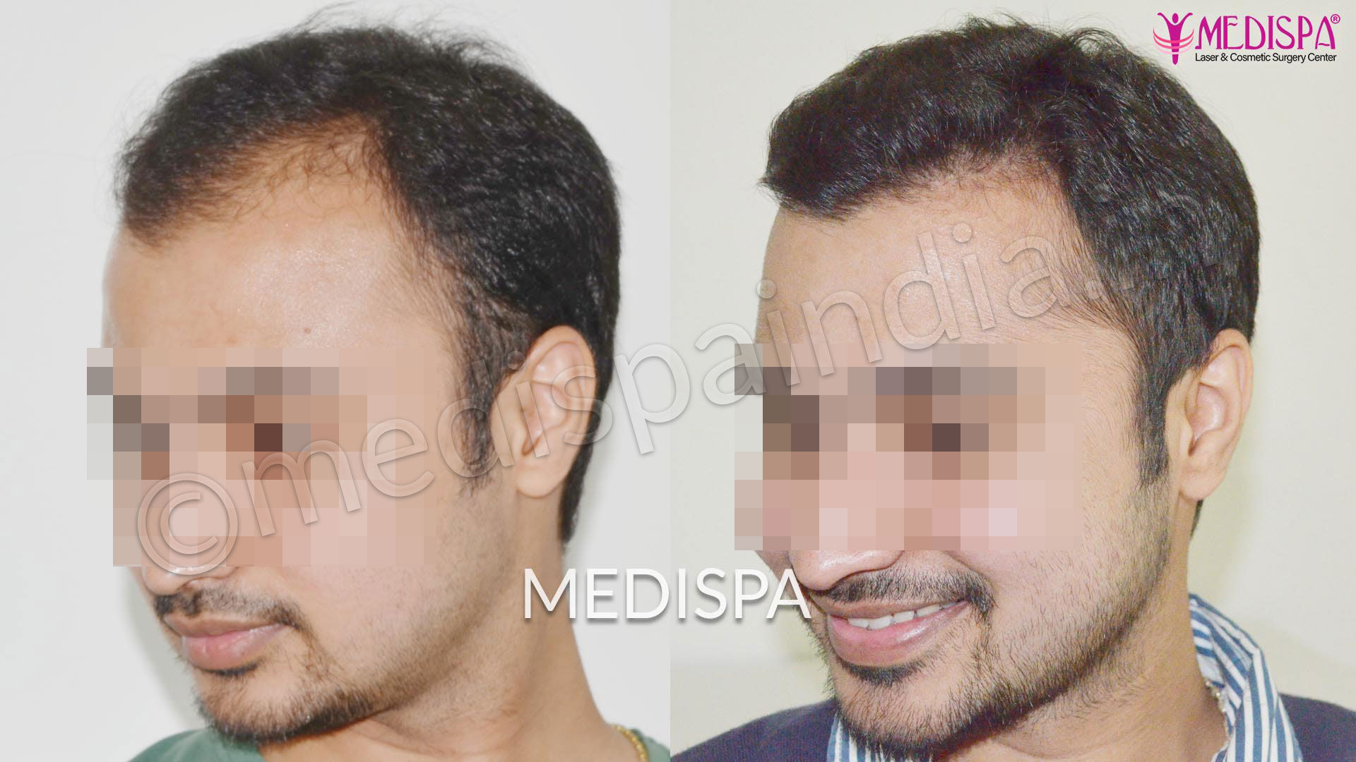 Hair Transplant in India