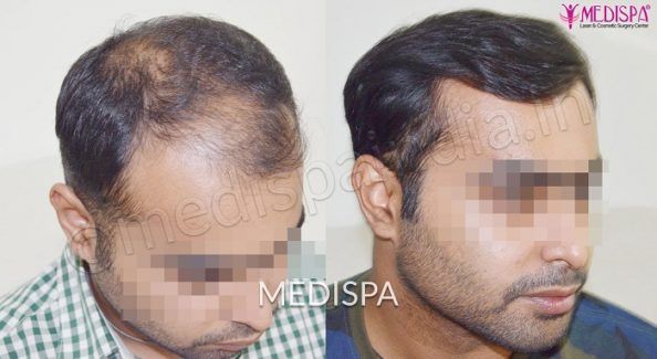 hair transplant in Dubai, UAE