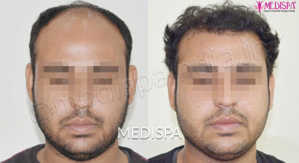 Hair Transplant in Mumbai