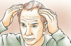 Achieving Appropriate Density in Hair Transplantation