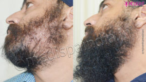 Moustache Hair Transplant